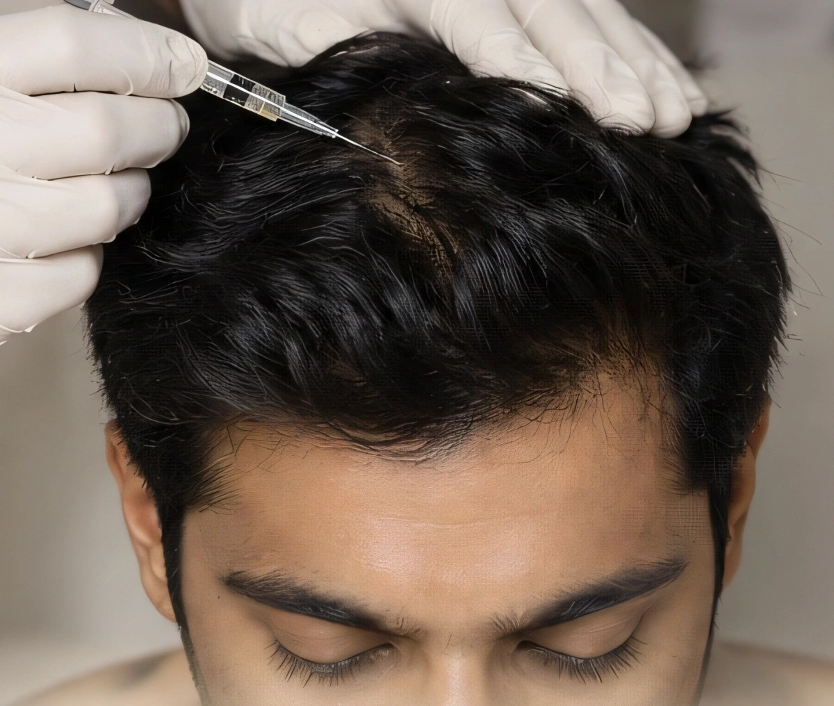 GFC / Exosomes / Mesotherapy