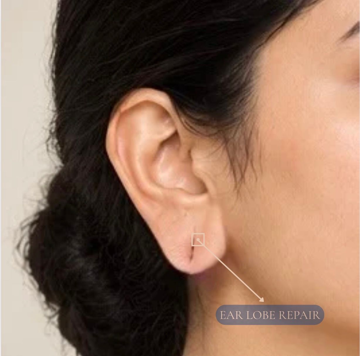 Ear Lobe Repair