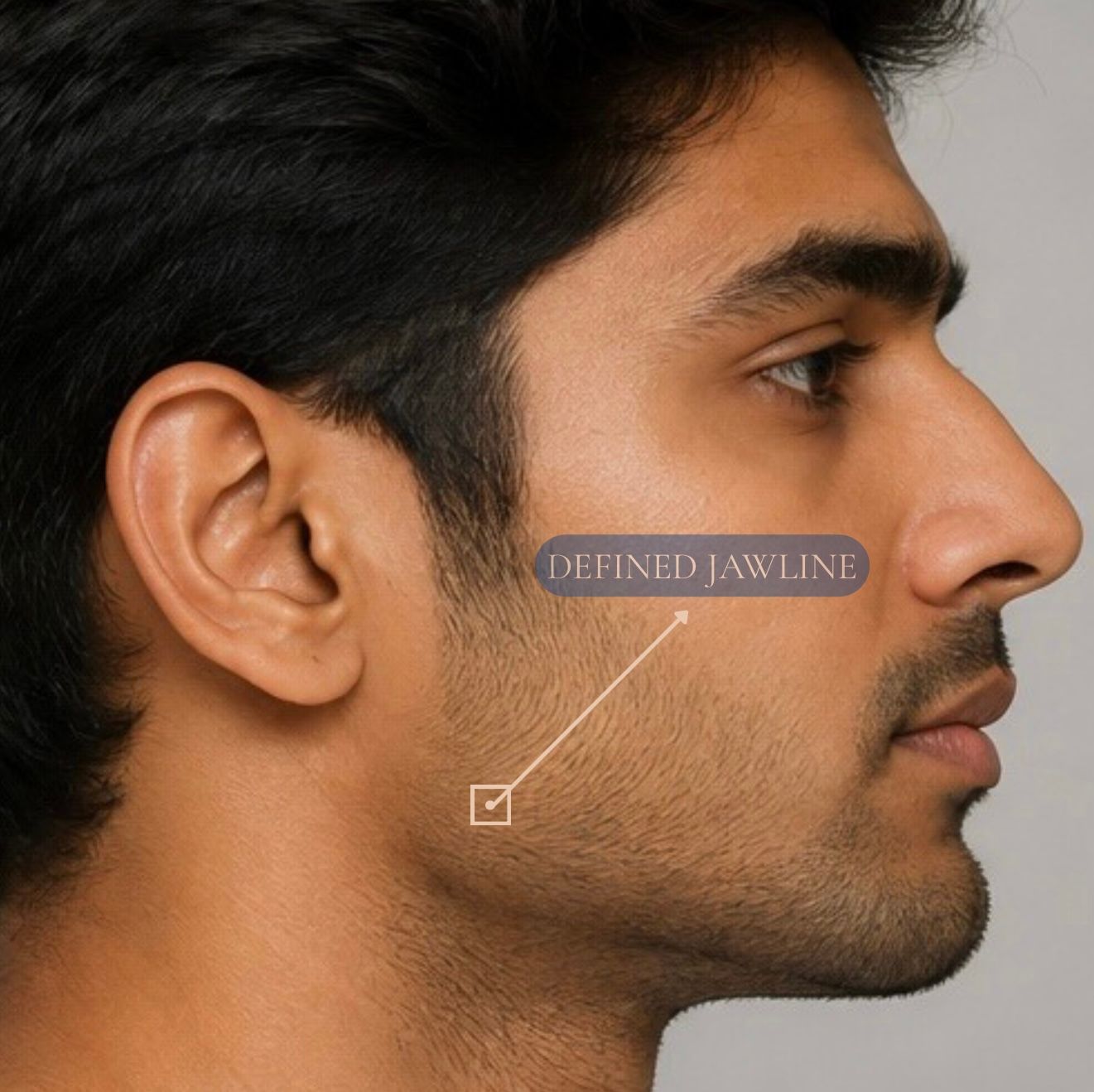 Jaw Angle Implants