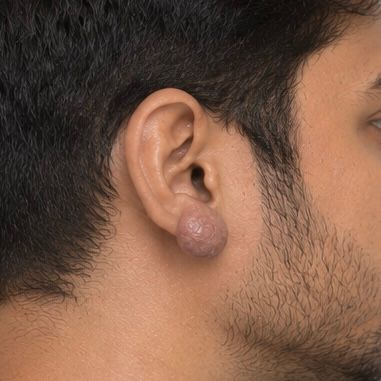 Keloid Management