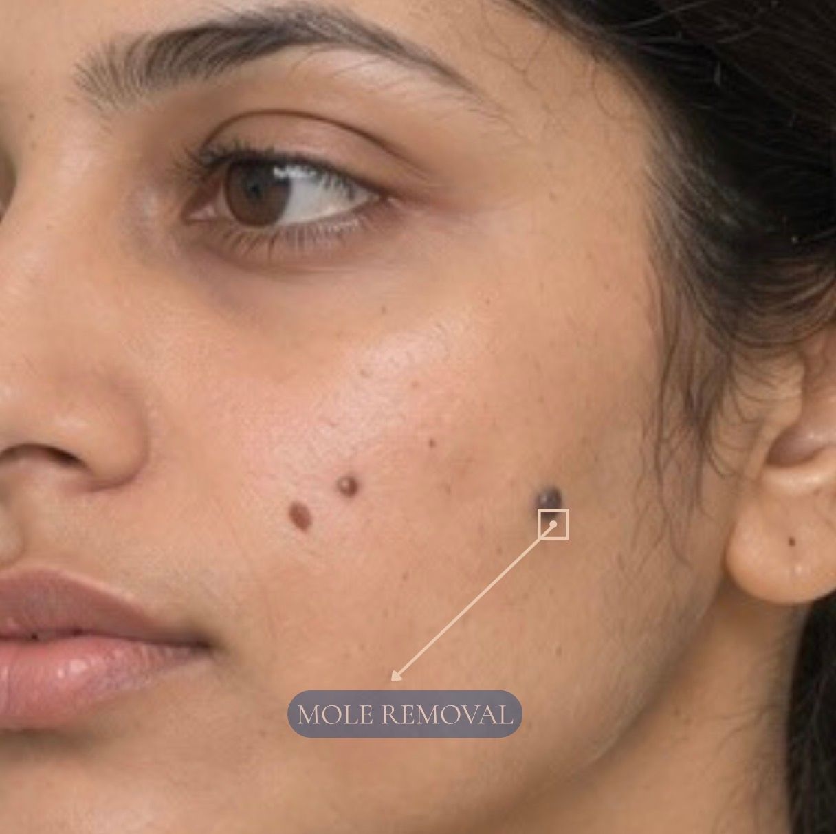 Mole Removal