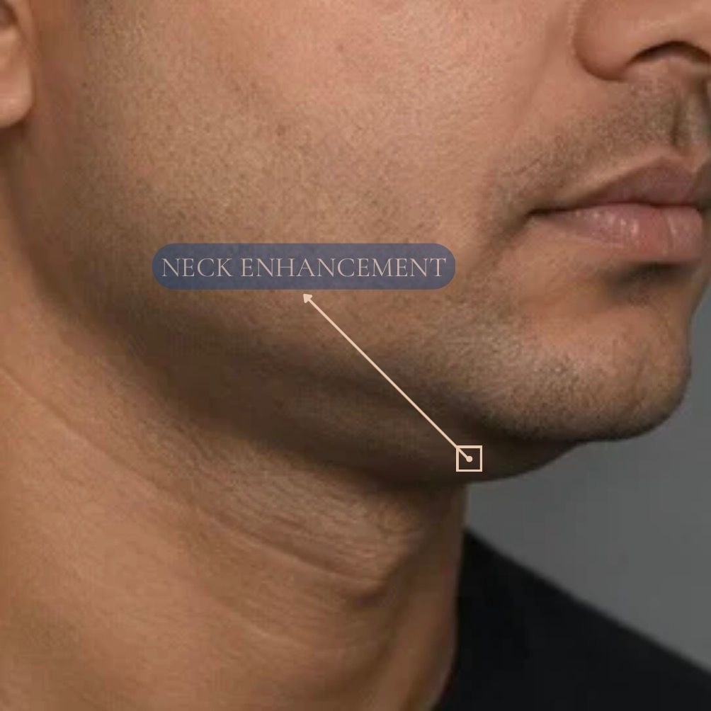 Neck Liposuction