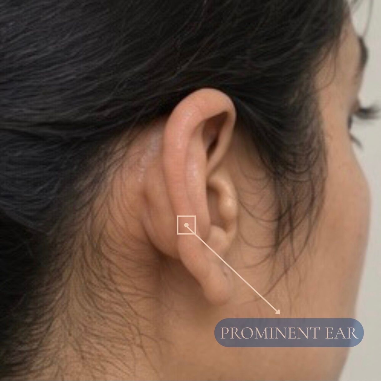 Otoplasty