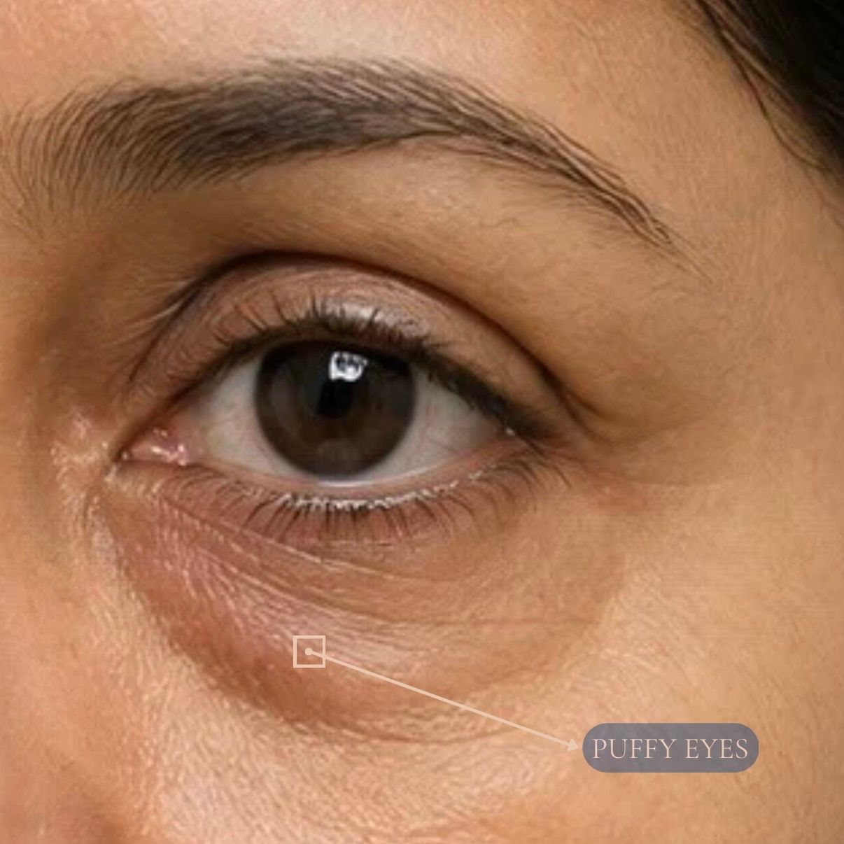 Under Eye Fat Bag Removal